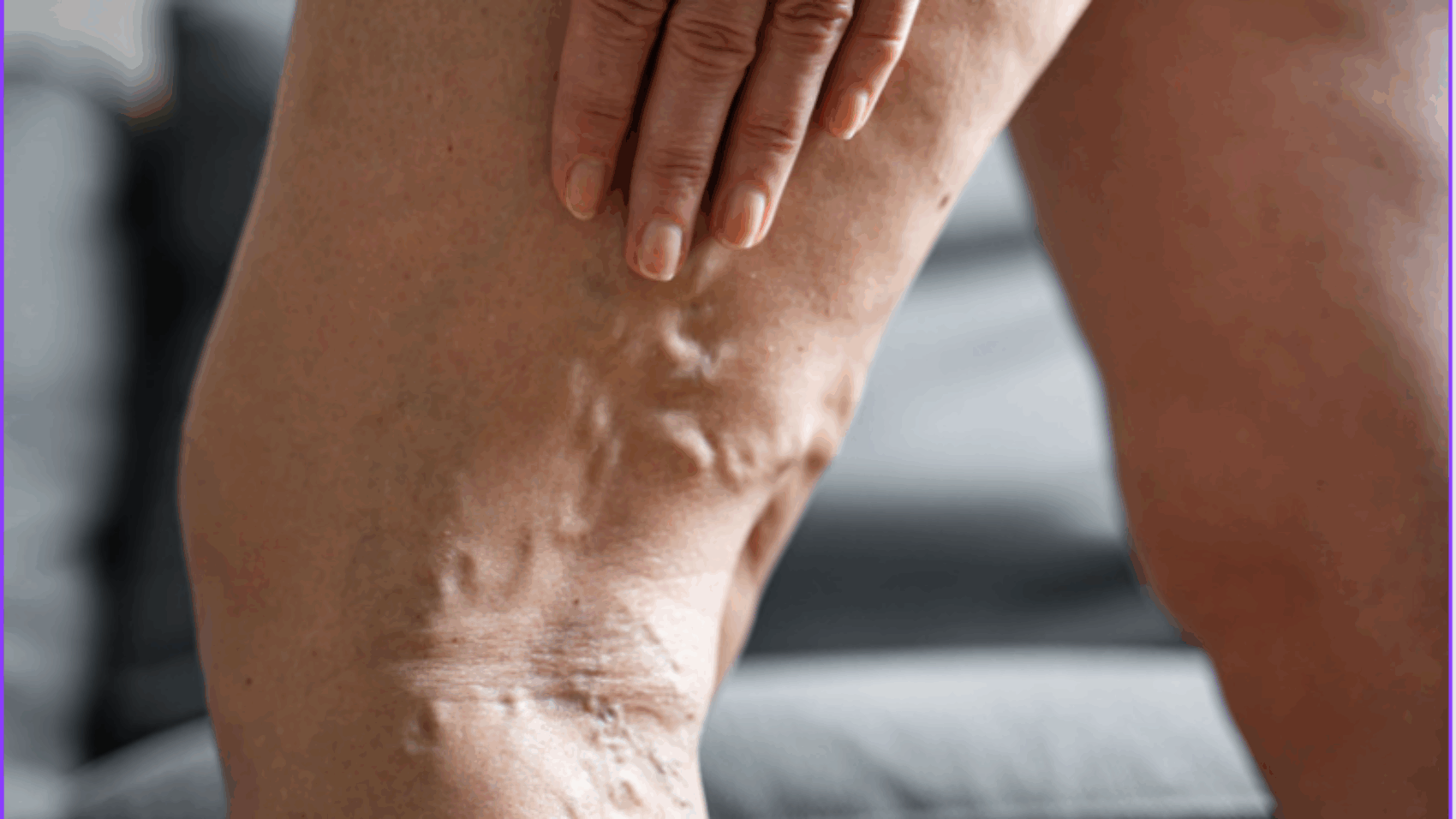 varicose-veins
