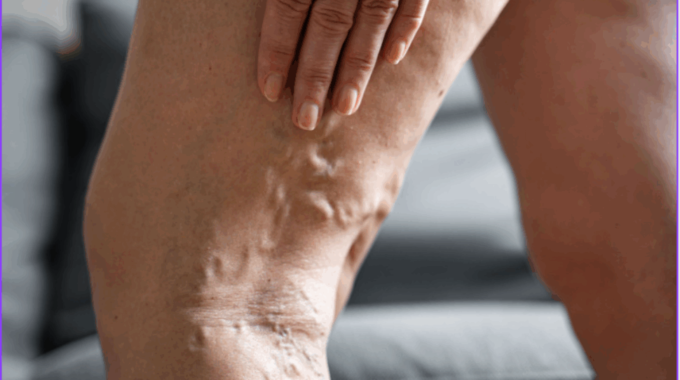 varicose-veins
